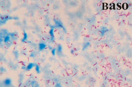 TB Stain (for pathologic Acid-Fast Stain)